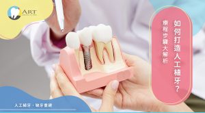 Read more about the article 如何打造人工植牙？療程步驟大解析