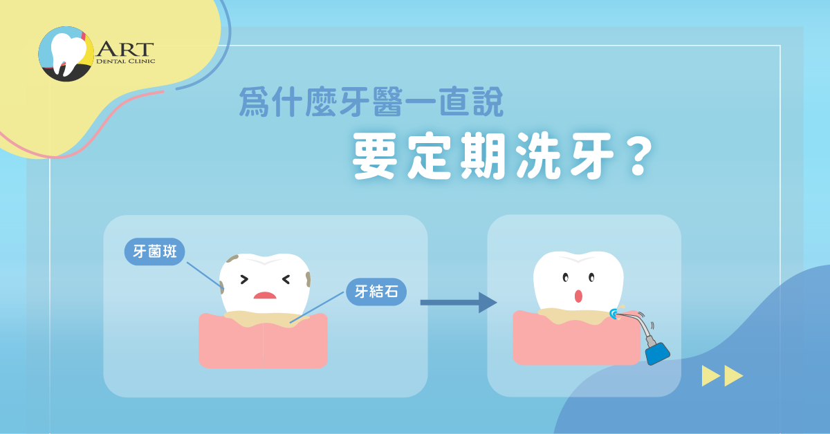 Read more about the article 為什麼牙醫一直說要定期洗牙？