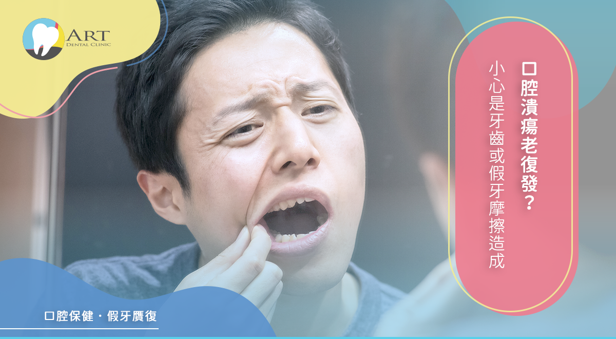 You are currently viewing 口腔潰瘍老復發?小心是牙齒或假牙摩擦造成