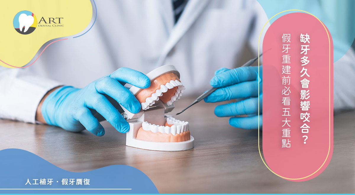 Read more about the article 缺牙多久會影響咬合？假牙重建前必看 5 大重點
